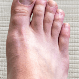 How Do I Know if My Toe is Broken or Just Bruised How Do I Know if My Toe is Broken or Just Bruised